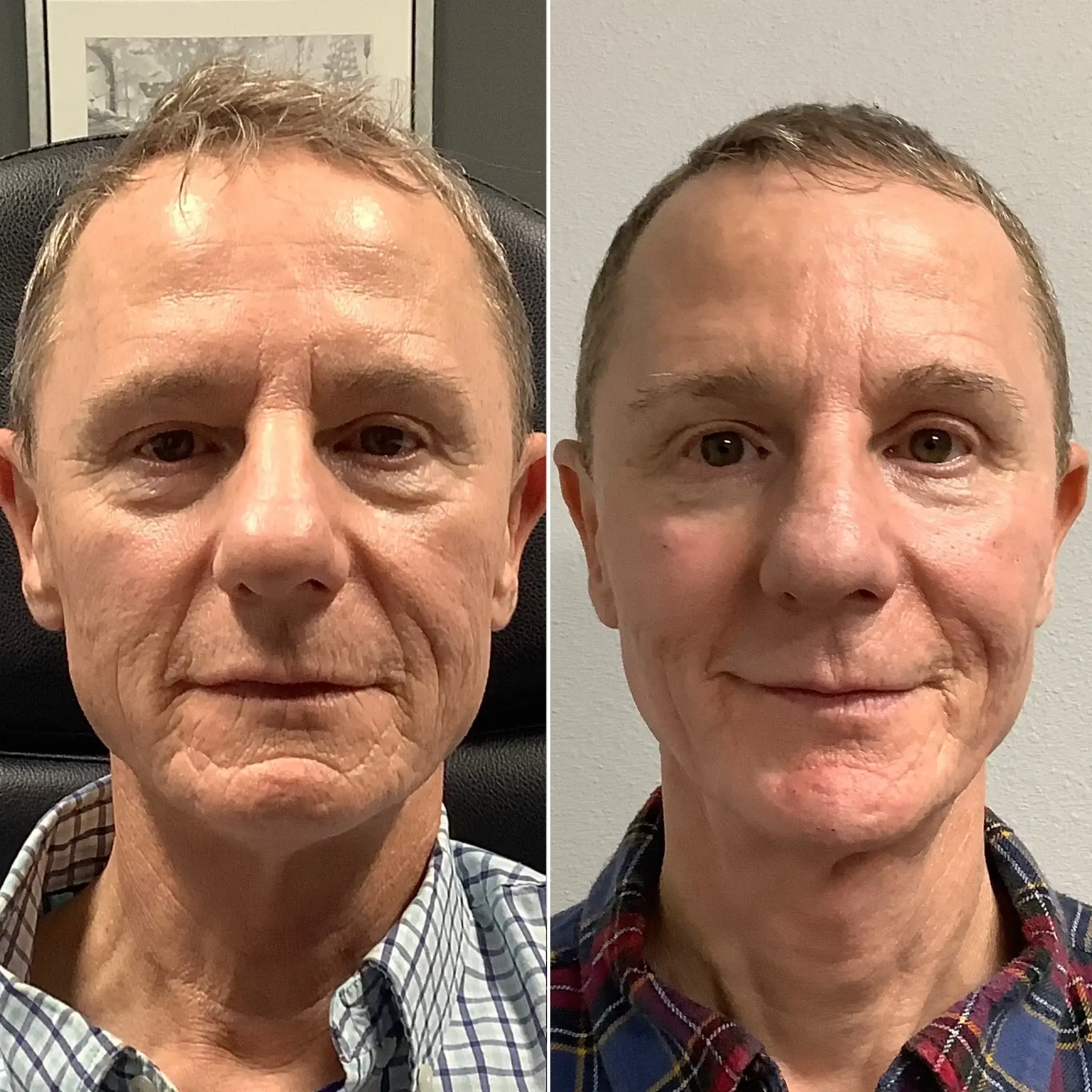 Before and after photos of a man after a dermal filler treatment at a Larkspur Med Spa