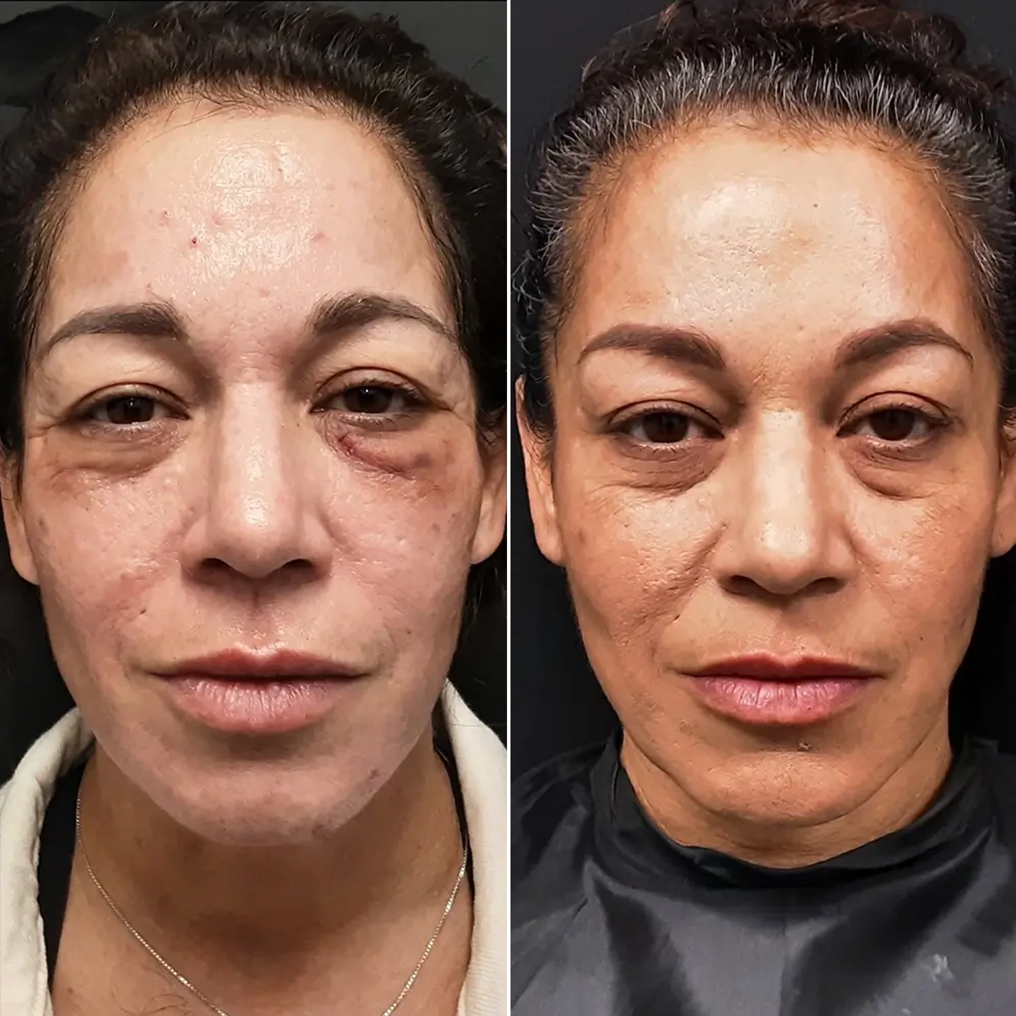 Wrinkles & Anti-Aging Laser Therapy - Larkspur Med Spa Before and after photos of a woman after a laser treatment at a Larkspur Med Spa